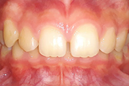 braces-bna5-before