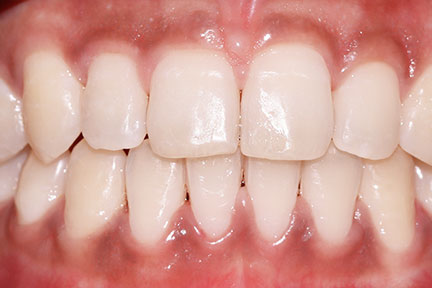 braces-bna6-after