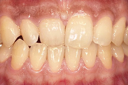 braces-bna6-before