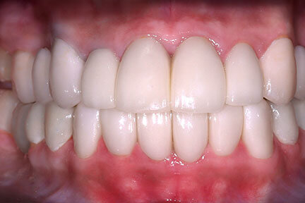 dental-bridge-bna1-after