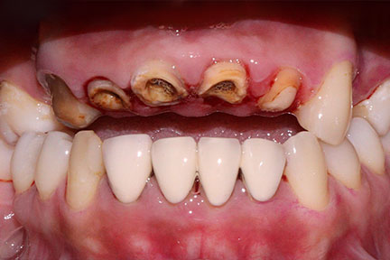 dental-bridge-bna1-before