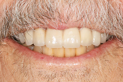 dental-bridge-bna2-after