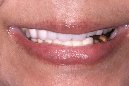 dental-bridge-bna3-before