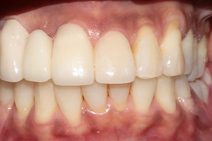 dental-bridge-bna4-after