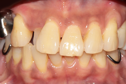 dental-bridge-bna4-before