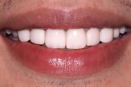 dental-bridge-bna5-after
