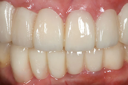 dental-bridge-bna6-after