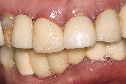 dental-bridge-bna6-before