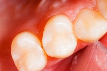 dental-filling-after