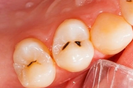 dental-filling-before