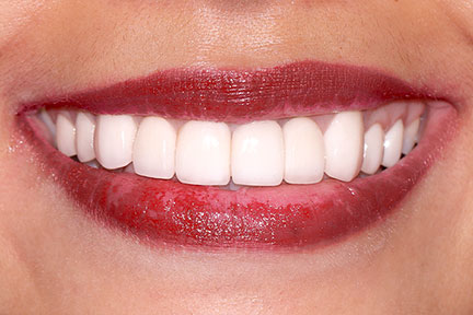 dental-implant-bna1-after