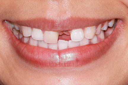 dental-implant-bna1-before