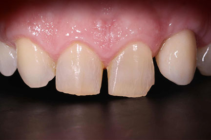 dental-implant-bna2-after