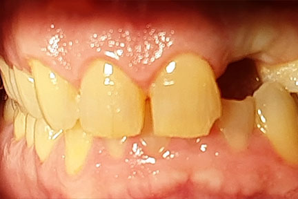 dental-implant-bna2-before