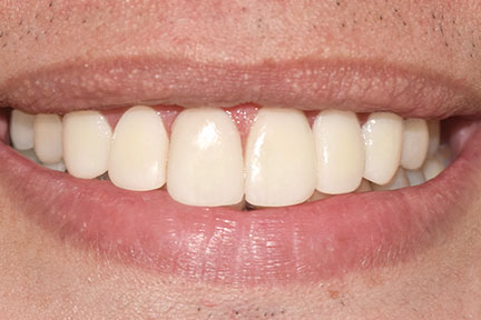 direct-veneers-bna1-after
