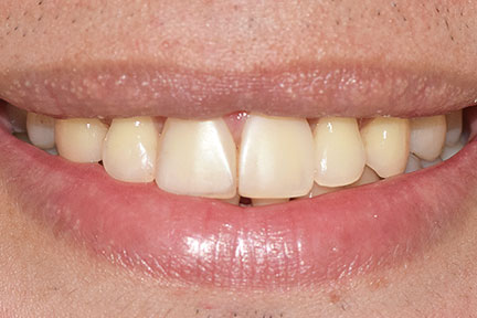 direct-veneers-bna1-before