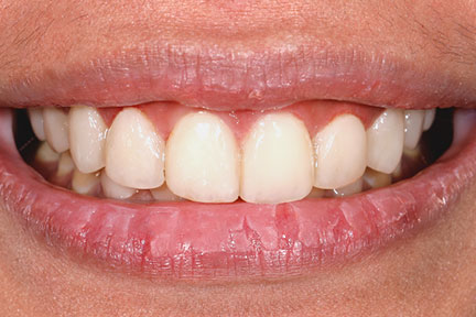 direct-veneers-bna2-after