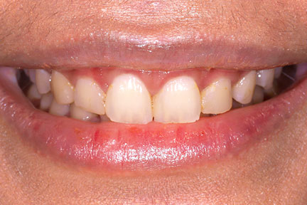 direct-veneers-bna2-before
