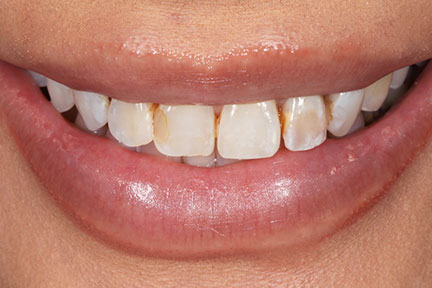 direct-veneers-bna3-before