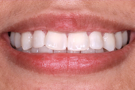 direct-veneers-bna4-after
