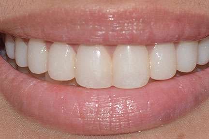 direct-veneers-bna4-after