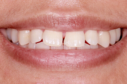 direct-veneers-bna4-before
