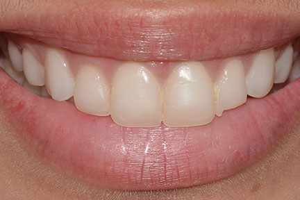 direct-veneers-bna4-before