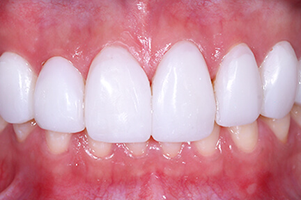 direct-veneers-bna5-after