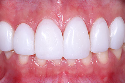 direct-veneers-bna5-after