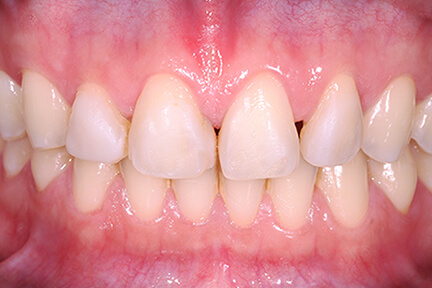 direct-veneers-bna5-before