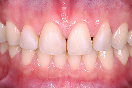 direct-veneers-bna5-before