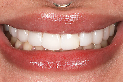 direct-veneers-bna6-after