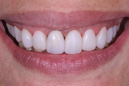 direct-veneers-bna6-after