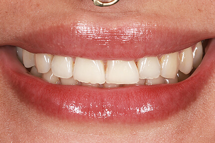 direct-veneers-bna6-before