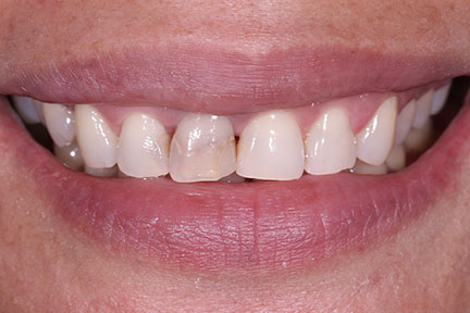 direct-veneers-bna6-before