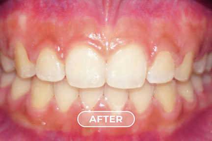 gaps-after