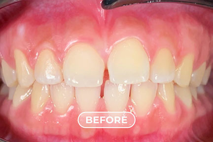 gaps-before