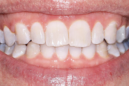 invisalign-bna1-after