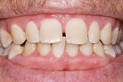 invisalign-bna1-before