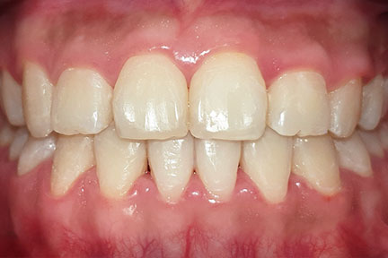 invisalign-bna2-after