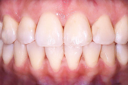 invisalign-bna2-after