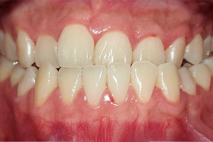 invisalign-bna2-before