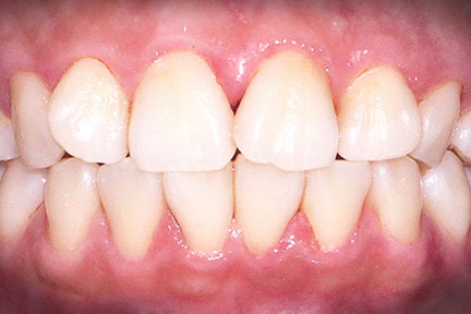 invisalign-bna2-before