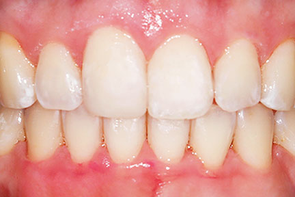 invisalign-bna3-after