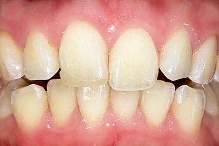 invisalign-bna3-before