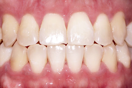invisalign-bna4-after