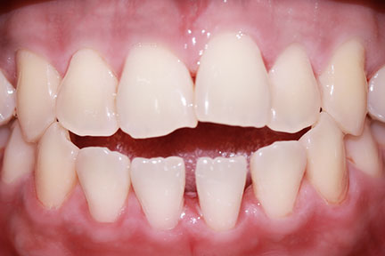 invisalign-bna4-before