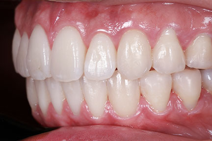 invisalign-bna5-after