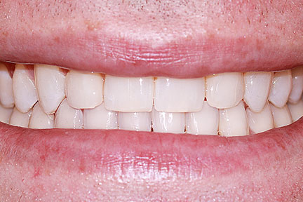 invisalign-bna5-after
