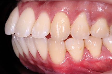 invisalign-bna5-before